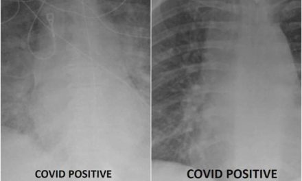 Radiografías muestran la diferencia del efecto de COVID en pacientes vacunados y no vacunados