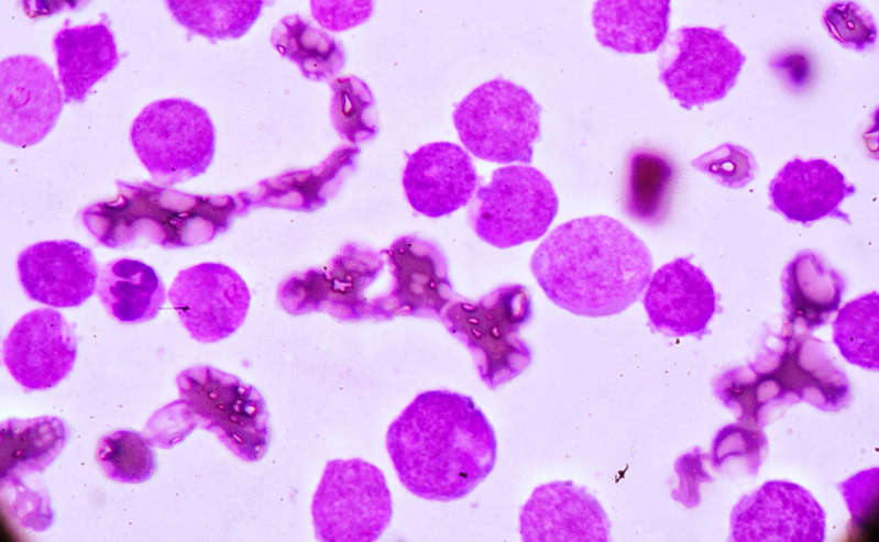 Aumenta la esperanza en más pacientes con la cura para la leucemia